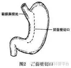 酒后吐血挂什么科,酒后吐血怎么止血