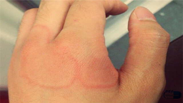 热性荨麻疹是怎样的症状如何治疗,什么是荨麻疹的特征性表现和症状