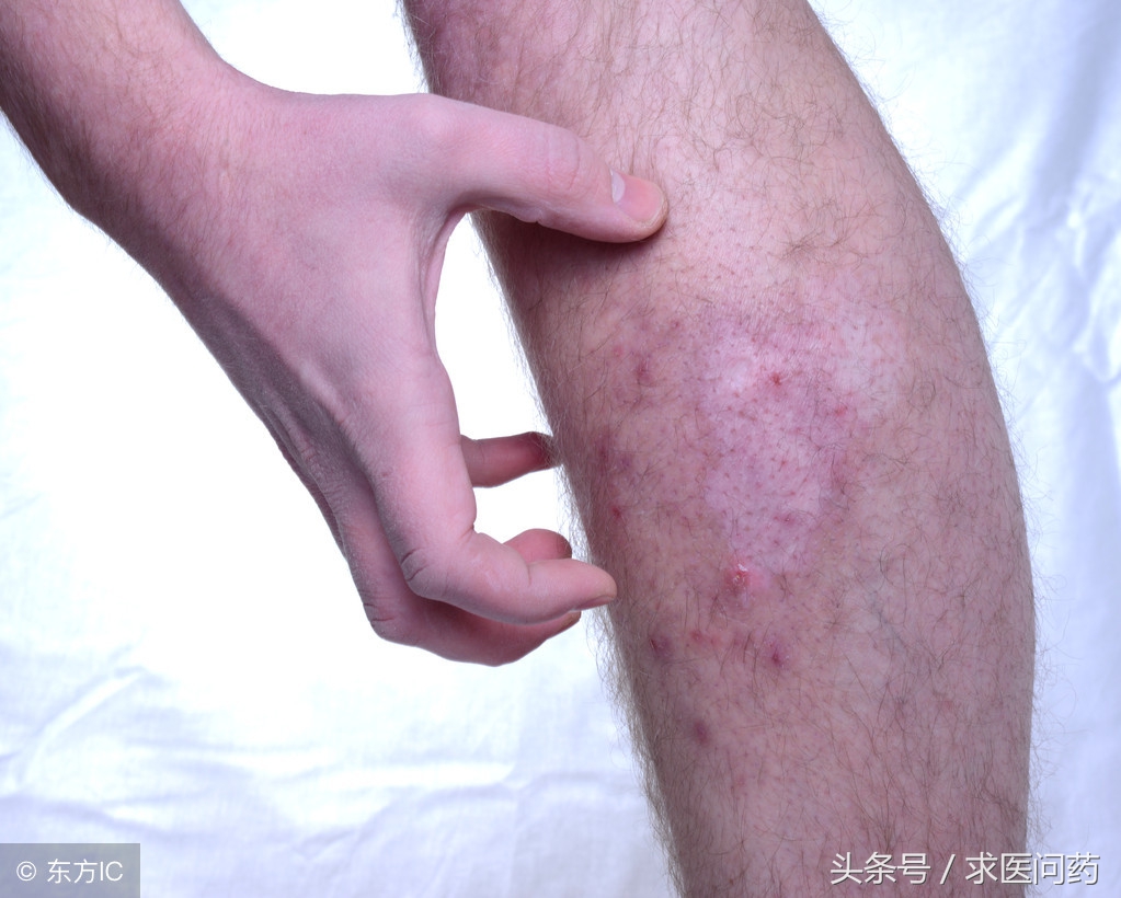 脖子瘙痒晚上加重越挠越痒,附睾附近瘙痒越挠越痒