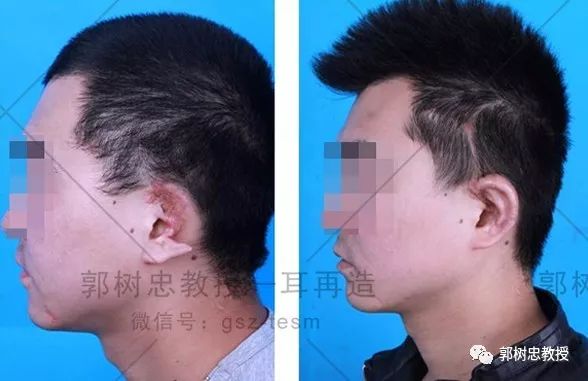 耳再造全过程,造耳朵技术