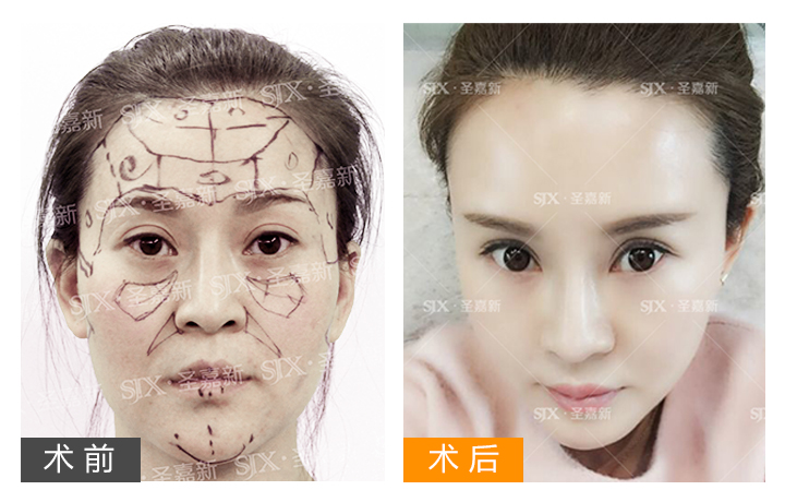 自体脂肪填充川字纹保持多久,自体脂肪填充10天内效果图