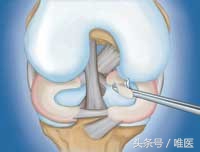 半月板损伤科普,膝盖半月板撕裂软骨脱落
