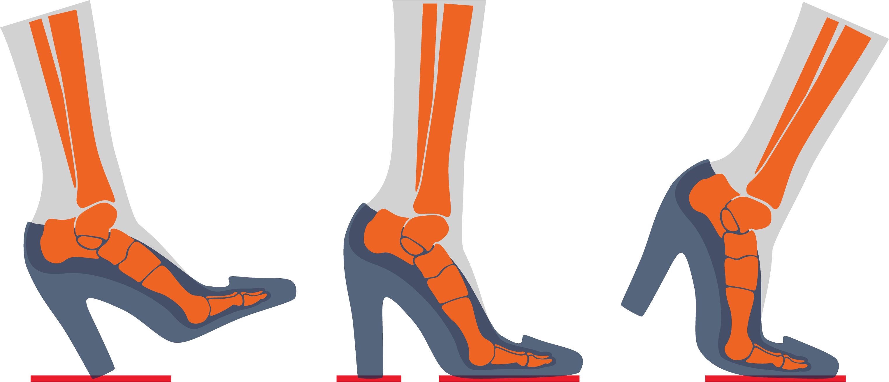 高跟鞋疼痛难忍,高跟鞋痛怎么处理