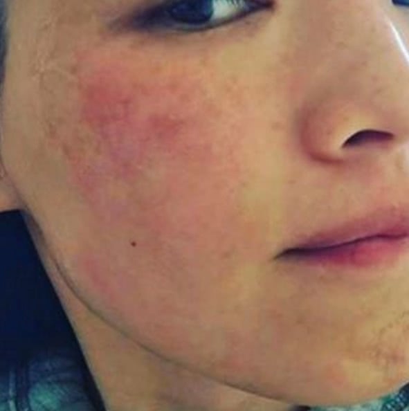 舒淇过敏都用什么护肤品呢,紫外线过敏舒淇