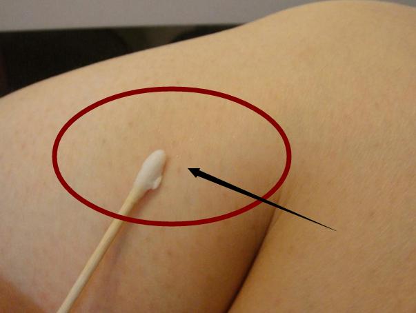 去除鸡皮肤一般用几天,去除鸡皮肤效果好快的产品