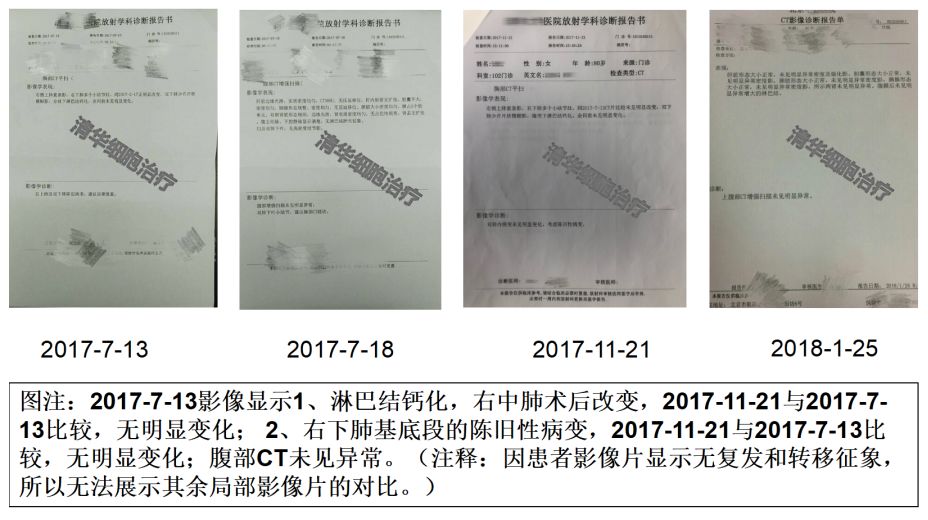 肺癌与黑色素瘤治疗,黑色素瘤导致的肺癌