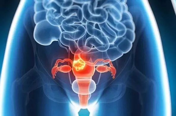 宫颈癌hpv疫苗真的有必要打吗,为什么有宫颈癌不能打hpv疫苗