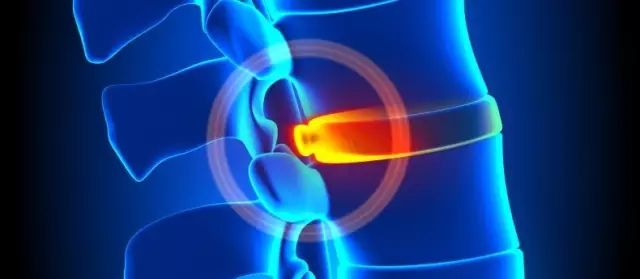 腰椎间盘突出的真相您了解吗,腰椎间盘突出是实证还是虚证