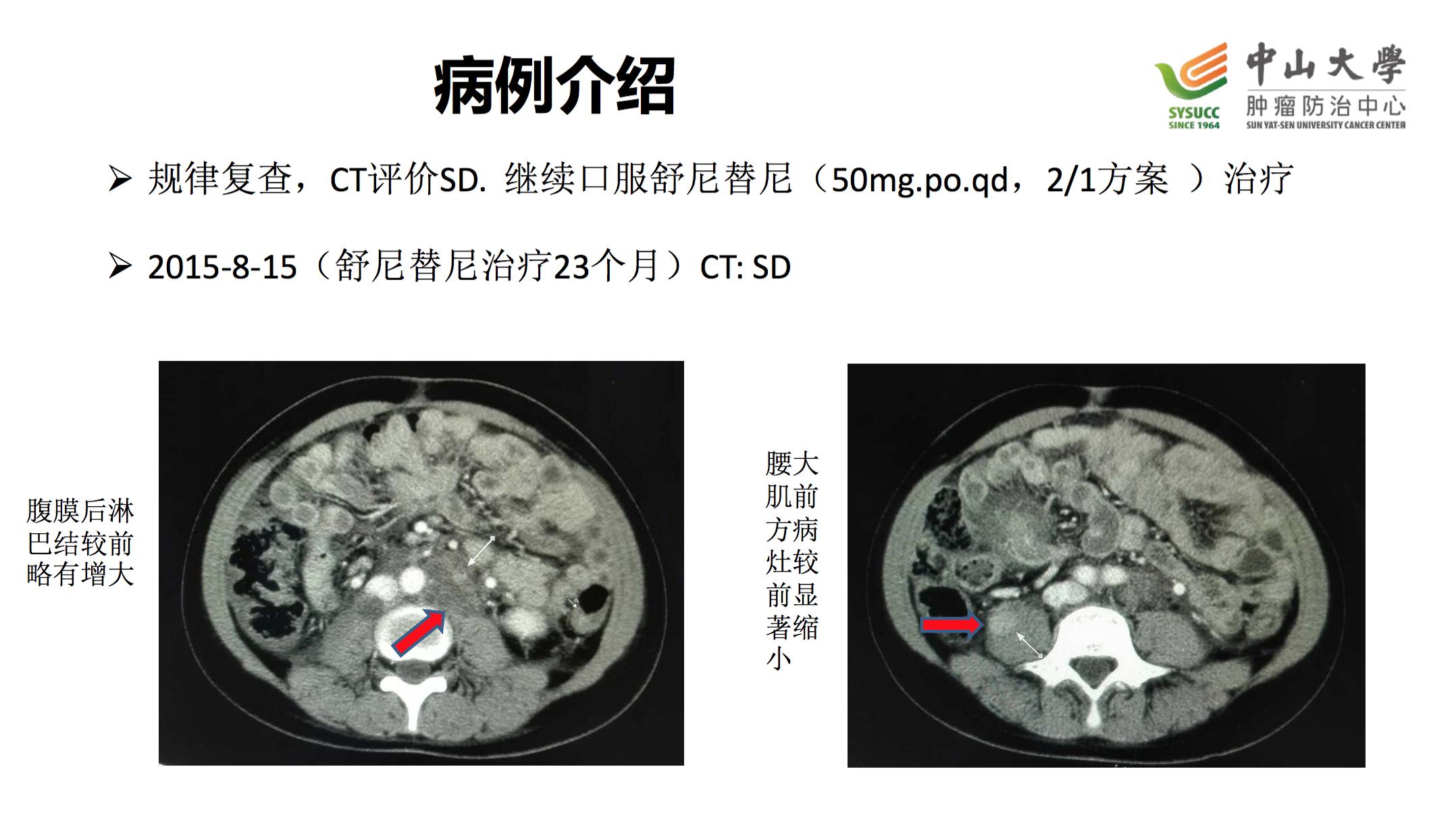 阿昔替尼联合单抗效果好吗,阿昔替尼联合免疫治疗肾癌