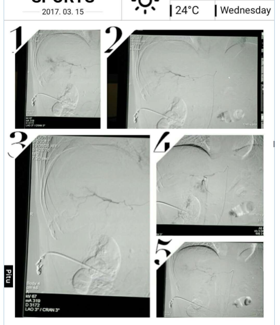 肝癌病例实例100例,肝癌的治疗方法论文