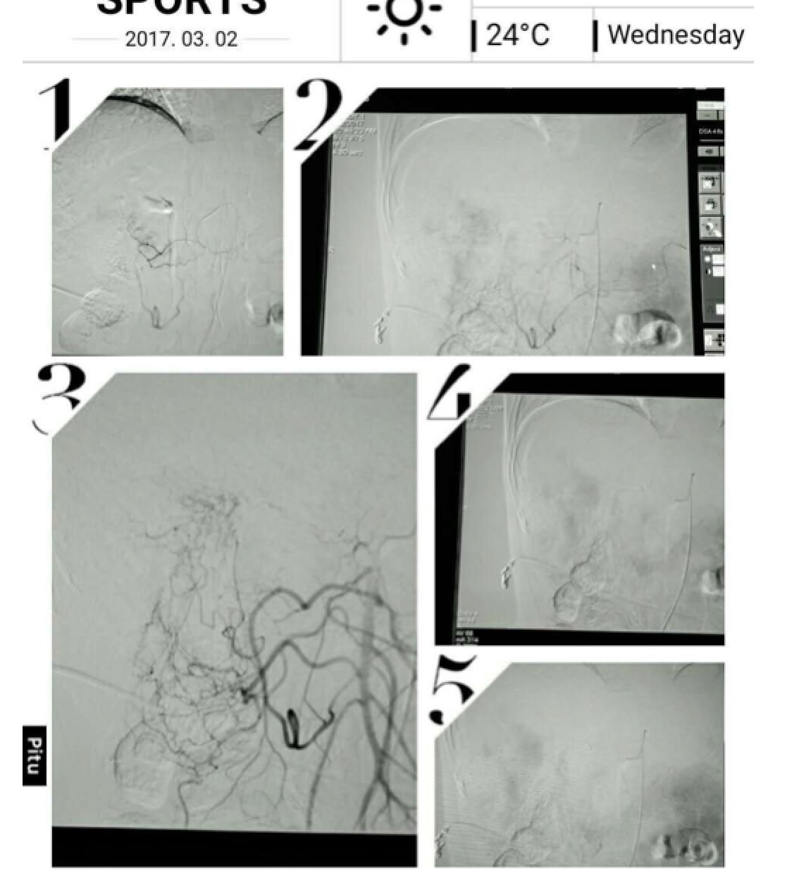 肝癌病例实例100例,肝癌的治疗方法论文