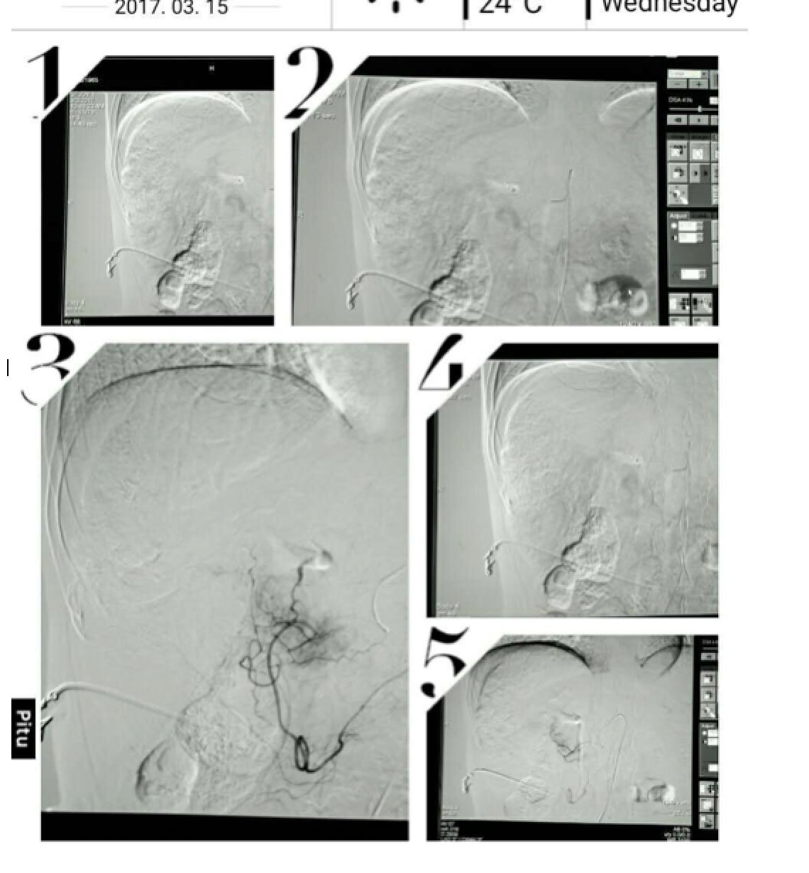 周仲国评价肝癌病例,周仲国分享肝癌早期复发