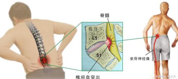 骨科疼痛原因和解析,慢性劳损性腰背痛怎么预防
