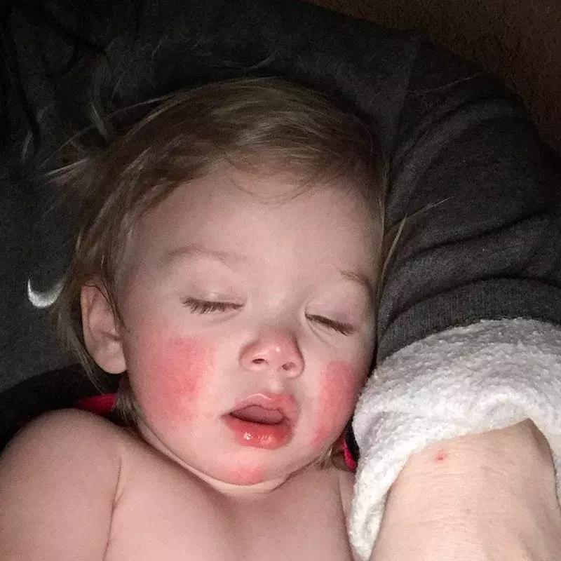 宝宝对净水器水过敏,对水过敏宝宝