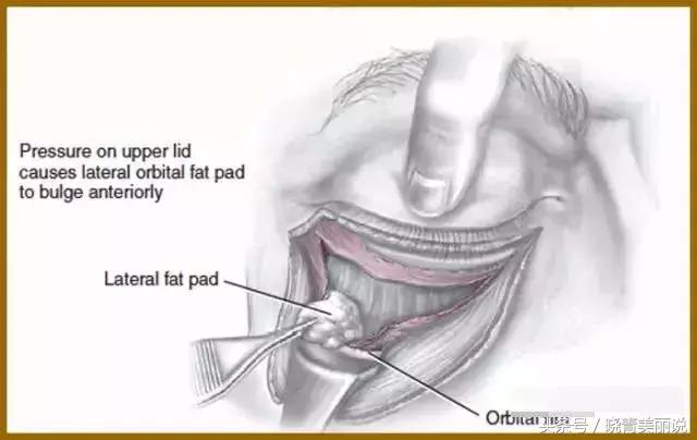 卧蚕会变成眼袋吗,卧蚕是怎么变成眼袋的