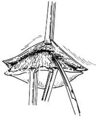 皮脂腺囊肿切除术多少钱,皮脂腺囊肿切除术