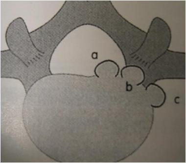 腰突和腰脱的磁共振片子,腰脱磁共振