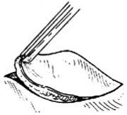 皮脂腺囊肿切除术多少钱,皮脂腺囊肿切除术