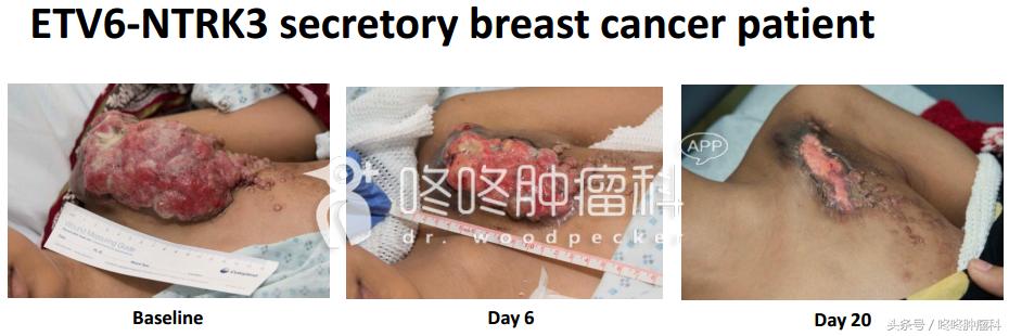 larotrectinib是靶向药吗,larotrectinib的靶向药