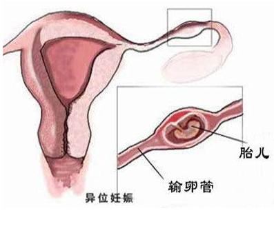 上环是避孕最好的方法吗?对身体会造成什么危害呢?