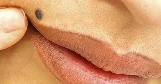 脸上长斑点痣,脸上长痣用药去好还是激光去好