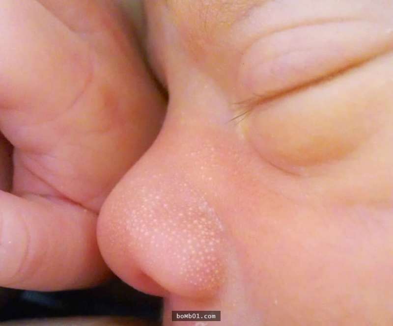 上眼皮上冒出来一个小白点,眼皮上有颗乳白色的小点