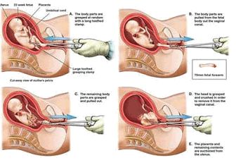 最好的人工流产方法是什么,人工流产是怎样做的