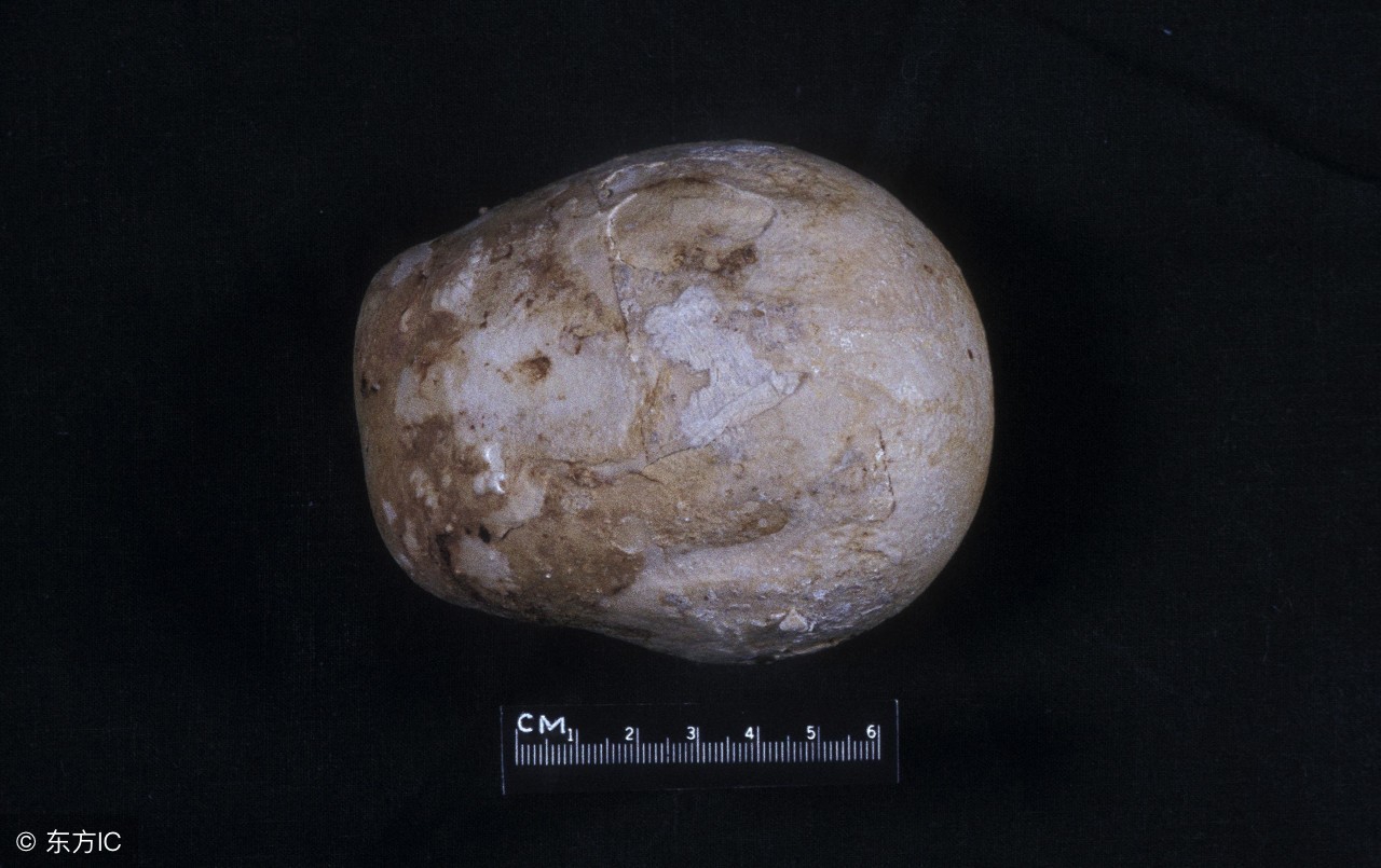 尿道结石应该忌口什么,尿道结石饮食注意事项