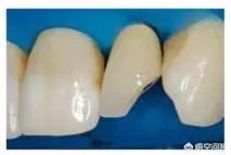 牙齿坏掉了长期不去补有什么影响,四五岁孩子的牙齿坏掉了怎么办