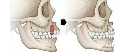 第一次整容日记,整容日记最经典的一段