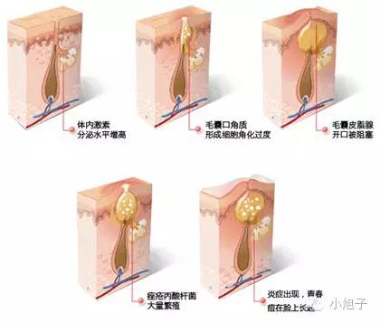 顽固草莓鼻怎么改善,消除草莓鼻的最快方法美容院