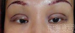 平行双眼皮割成了欧式双眼皮,割了个欧式双眼皮