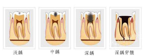 牙齿长虫了,牙齿长了虫洞