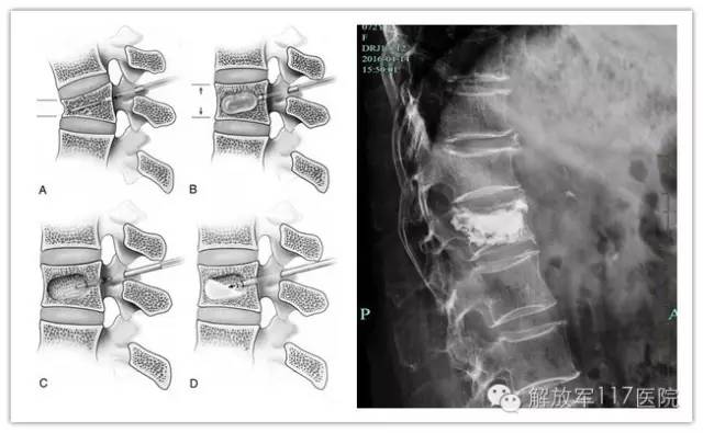 老人91压缩性骨折的最佳治疗方法,80岁老人11椎体压缩骨折怎么治疗