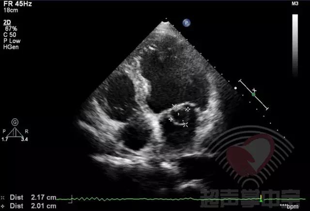 二尖瓣充血性囊肿,二尖瓣血性囊肿是什么意思