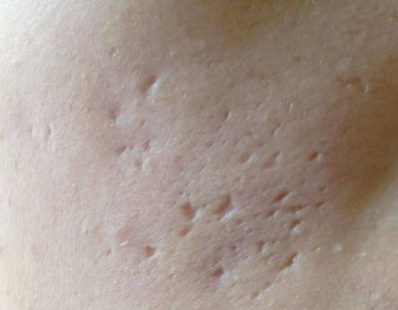 脸上有痘印痘坑怎么去修复,脸上痘坑凹洞怎么修复