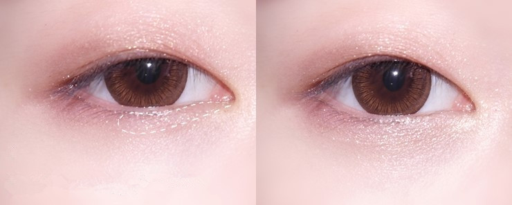 怎么不整容内双变成外双,不用整容缩小鼻头