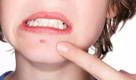 祛上火痘痘的方法,快速祛上火痘小妙招