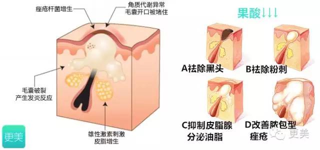果酸换肤是整容吗,果酸换肤不做后会复发吗