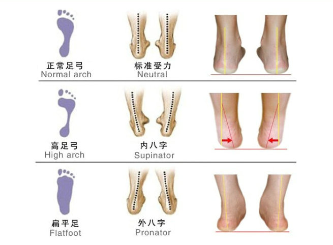 扁平足需要垫足弓吗,扁平足足弓套有用吗
