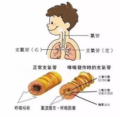 孩子咳嗽喘就一定是细菌感染吗,孩子老是咳嗽是不是支原体感染