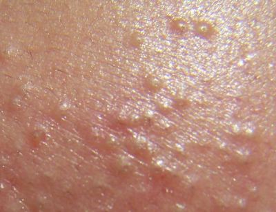 你还敢挤痘痘吗,怎么用简单的方法祛痘痘和消痘