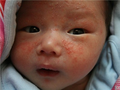 宝宝一热就起湿疹怎么办,宝宝脸上反复湿疹怎么办