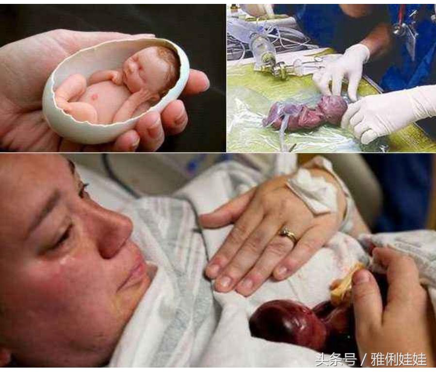 前置胎盘老是出血能保胎到足月吗,中央型胎盘前置保胎经历