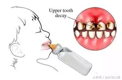 乳牙蛀了不疼要补牙吗,乳牙蛀了要不要治疗