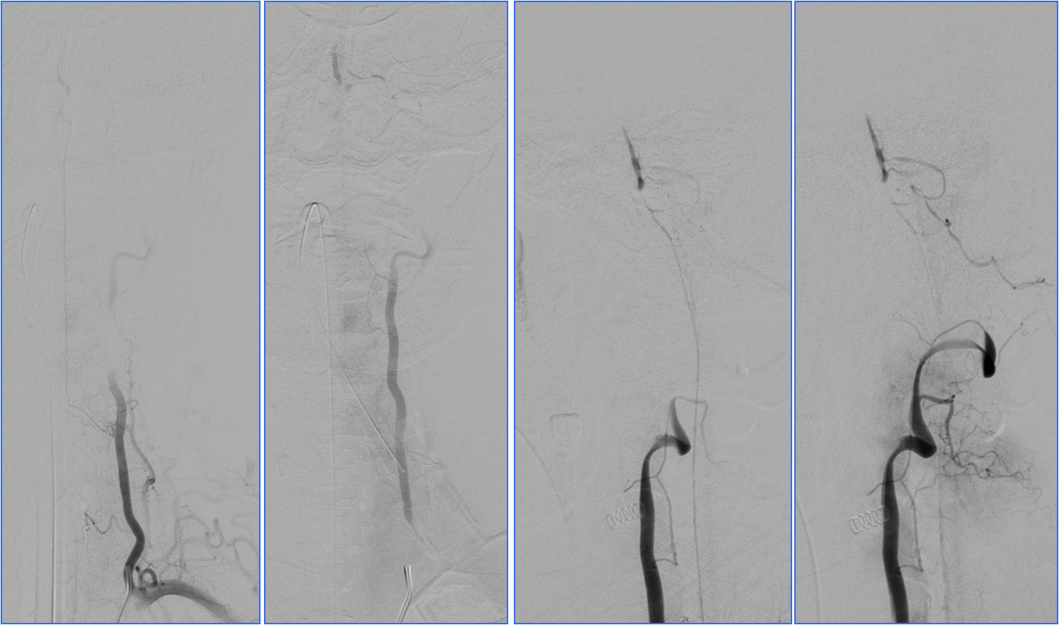 缺血性脑卒中术后管理,急性缺血性脑卒中血管内治疗