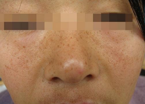 男性怎么治疗由电脑辐射引起的*褐斑黄**