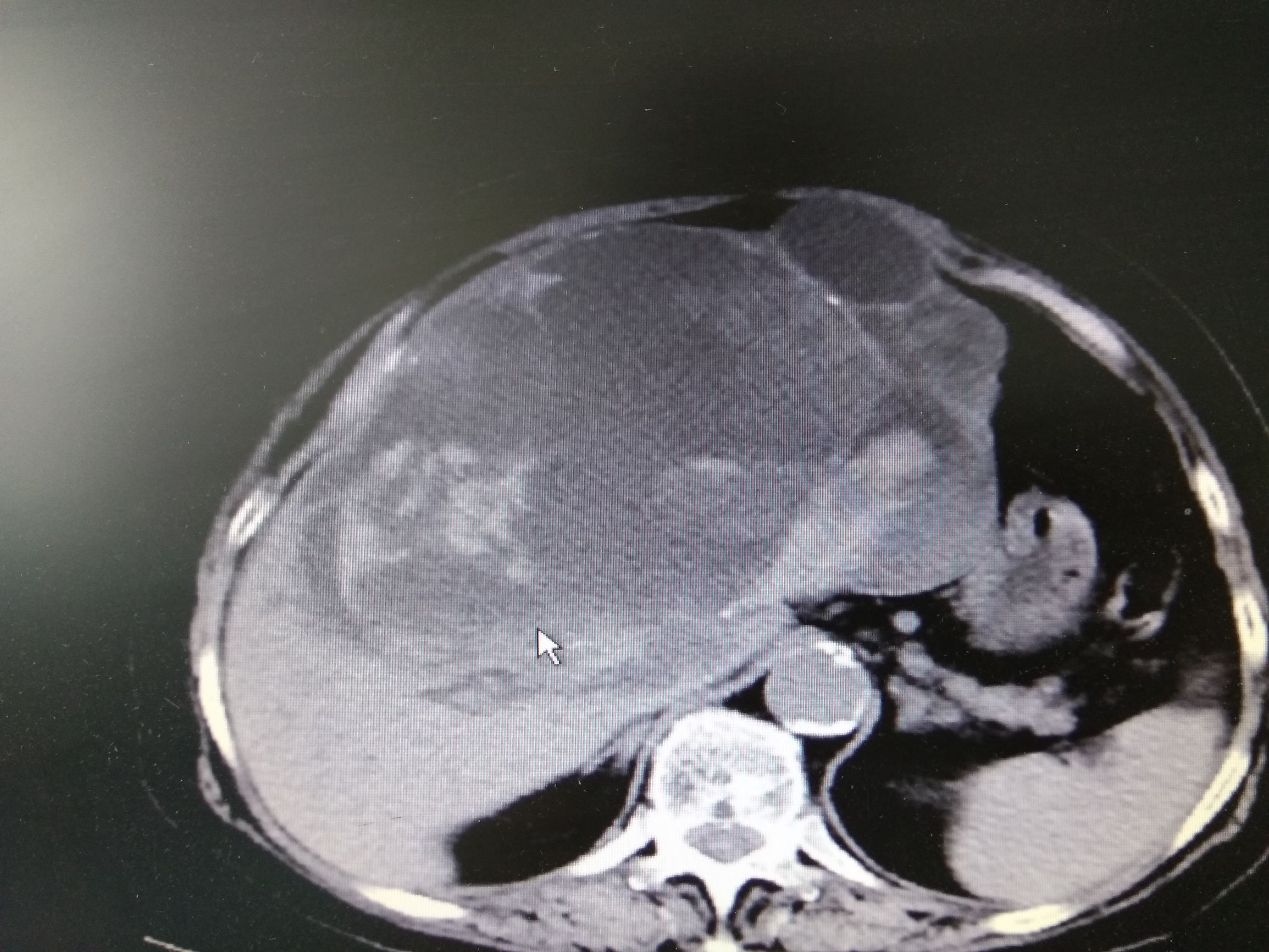 她被检查出患癌晚期,小医院查出肝囊肿有可能是癌吗