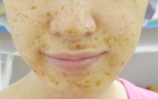 满脸斑淡斑并不难试试这个方法,淡斑小妙招长斑的女人快来看看吧