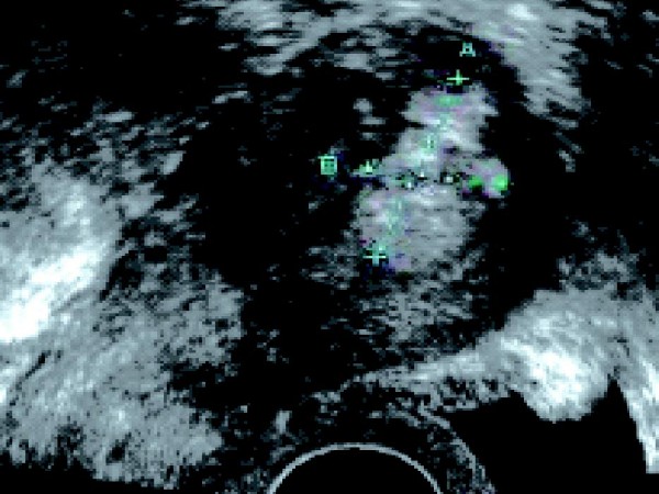 急症查流产征兆,医学检查流产